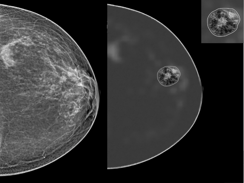 Breast-SlimView: αρχική εικόνα και negativation