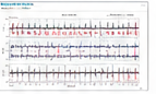 Holter ECG