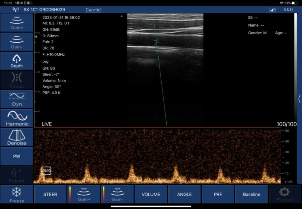 SonoStar PW Doppler