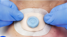 Tracheseal 5